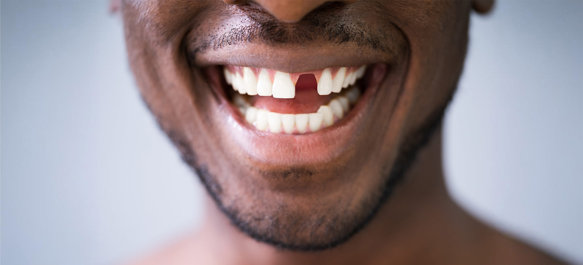 masri-dental-fresno-18 a close up of a man's mouth