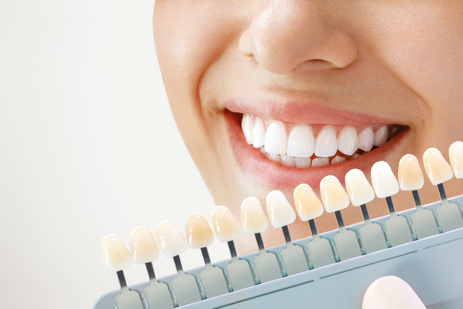 close-up of a woman's smile and a palette of teeth